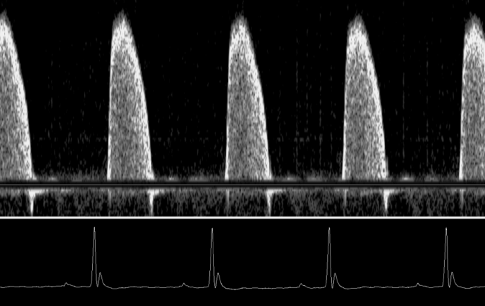 A Noninvasive Alternative to +dP/dtmax: Peak Aortic Blood Acceleration