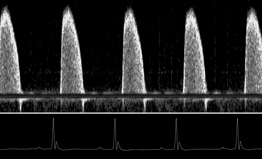 A Noninvasive Alternative to +dP/dtmax: Peak Aortic Blood Acceleration