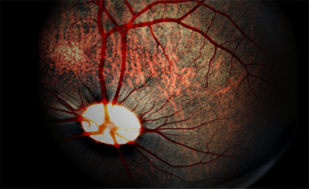 Studying Retinal Function in Large Animals: Laser-Induced Choroidal Neovascularization in Pigs