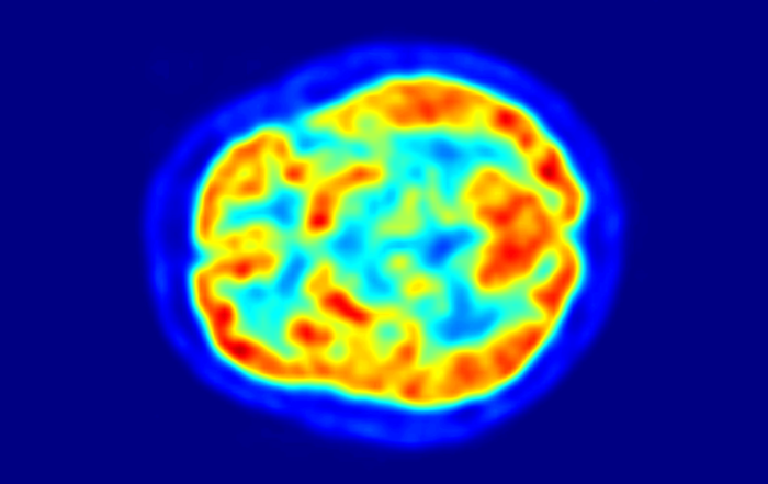 A New Frontier of Precision Medicine: Using PET for Image-Guided Neurointerventions