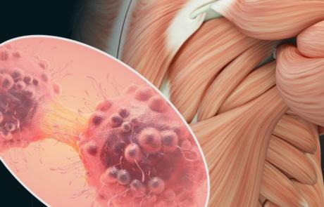 Musculoskeletal Complications of Cancer and its Treatments
