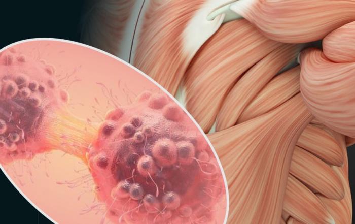 Musculoskeletal Complications of Cancer and its Treatments