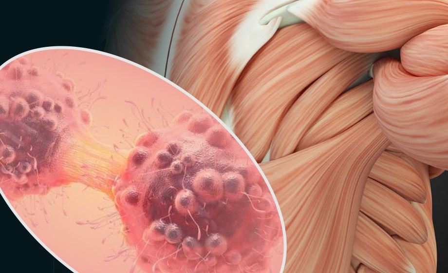 Musculoskeletal Complications of Cancer and its Treatments