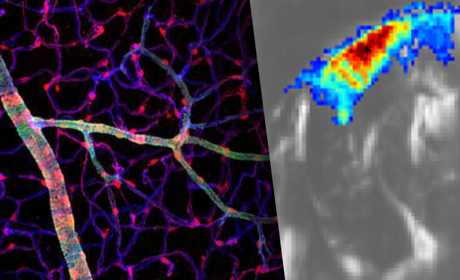 Microvascular & Functional Ultrasound Imaging- Insights into Stroke and Neurovascular Diseases