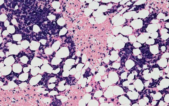 A Novel 3D High Throughput Co-culture System for Multiple Myeloma