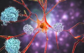 amyloid plaques and neurofibrillary tangles