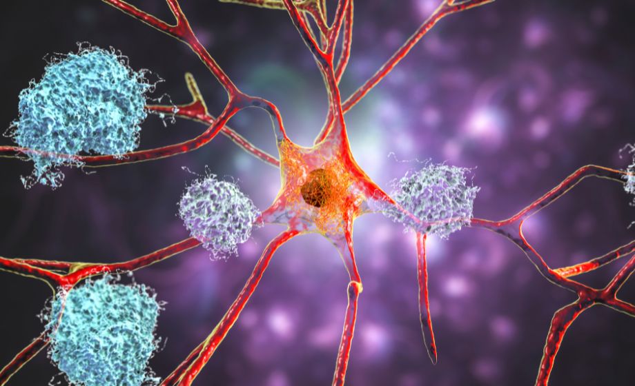 amyloid plaques and neurofibrillary tangles
