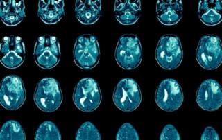 Glioblastoma multiforme therapeutics FI