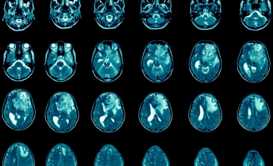 Glioblastoma multiforme therapeutics FI