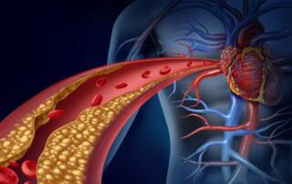 GPR55 Atherosclerosis FI