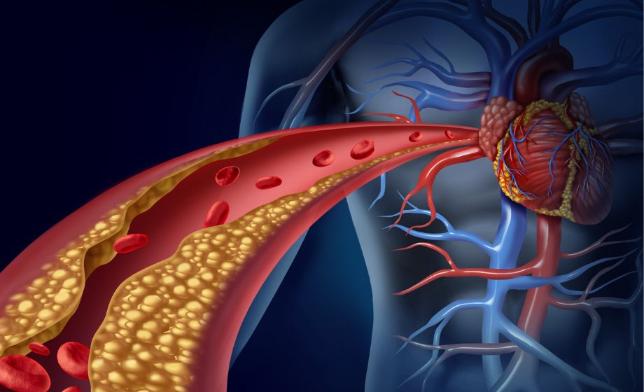 GPR55 Atherosclerosis FI