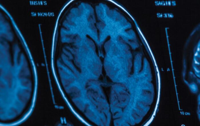 Understanding Intracranial Pressure in Freely Moving Rats