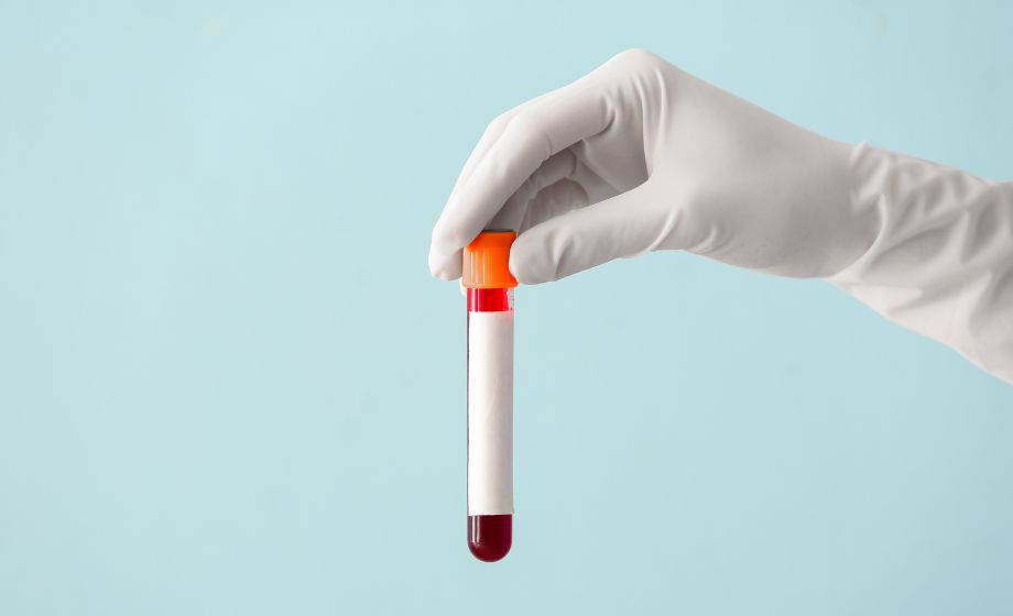 Brain-Derived Tau in Blood for Alzheimer's Disease Diagnosis FI