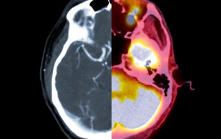 CT scan of the brain Axial view and PET CT SCAN.
