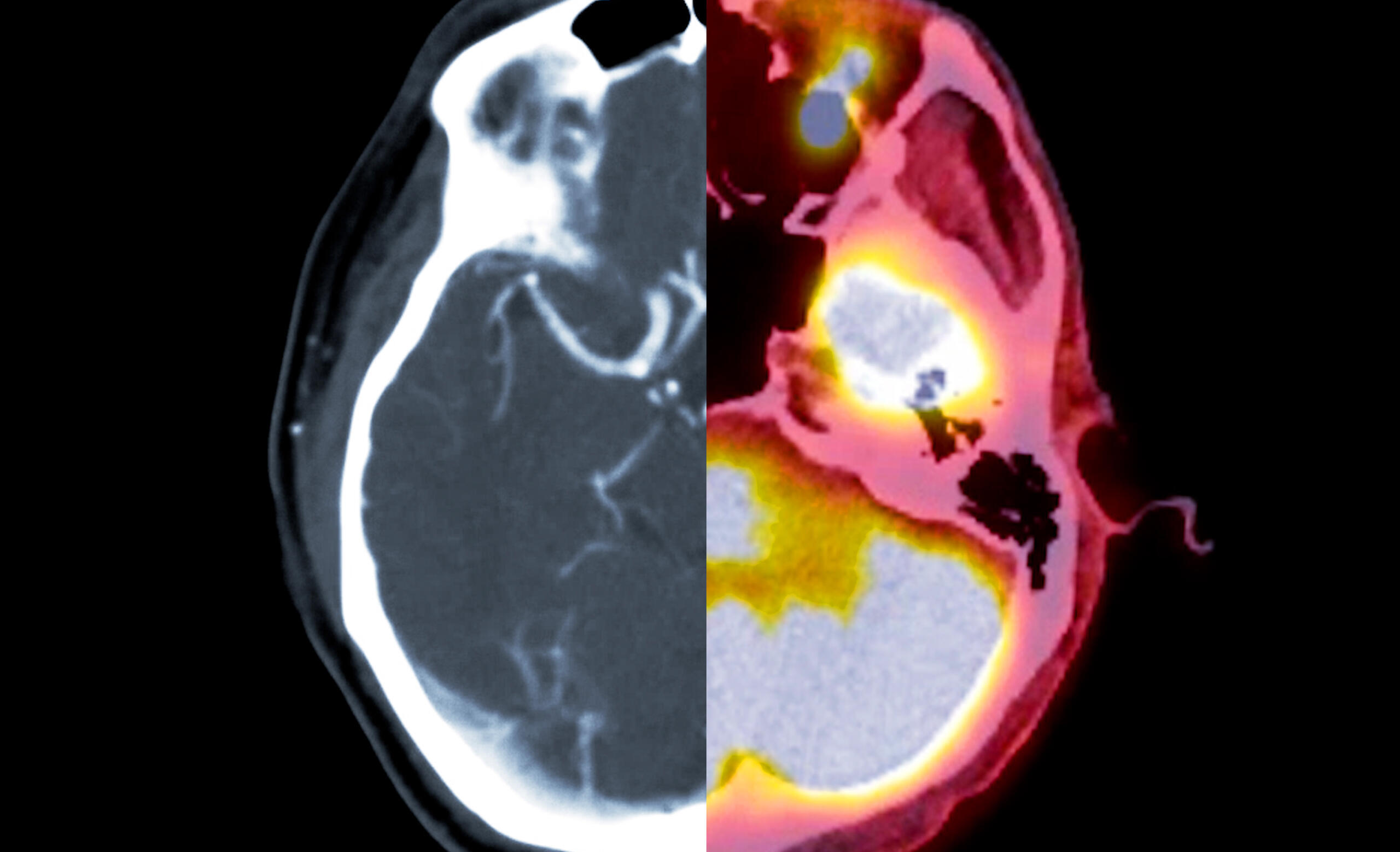 CT scan of the brain Axial view and PET CT SCAN.