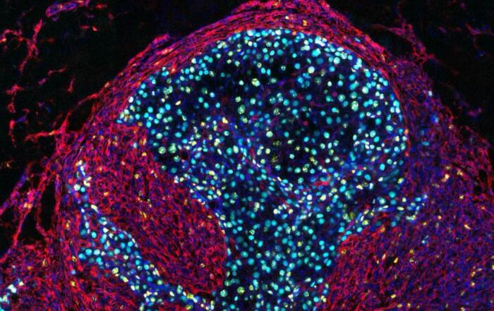Unraveling Immunotherapy Resistance in Advanced Melanoma: Novel Insights from Longitudinal Spatial Multiomics Studies